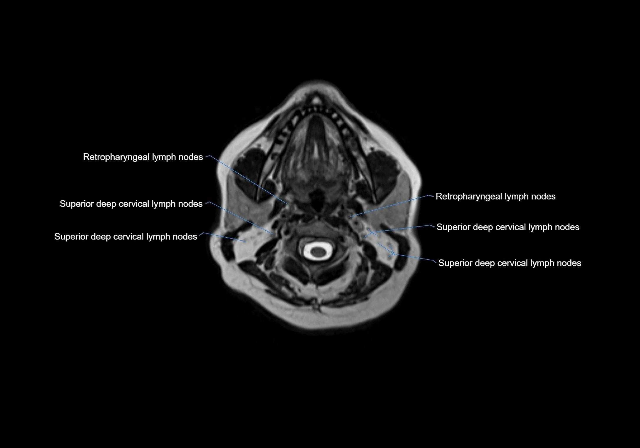 Neck axial  lymph node cross sectional MRI anatomy 3T MRI  image-img-00001-00042.webp